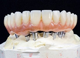 Model of implant dentures