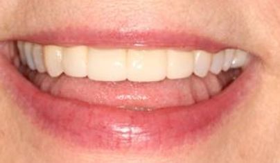 Healthy perfected smile after cosmetic dentistry