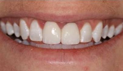 Smile after damaged tooth is repaired
