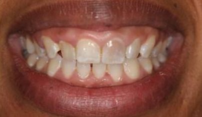 Dark and discolored teeth before restorative dentistry