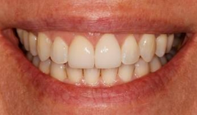 Healthy white smile after teeth whitening