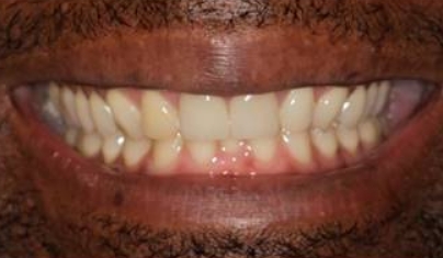 Smile after repairing broken front teeth