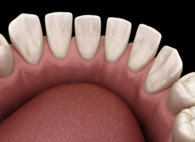 endering of a lower arch of teeth that are widely spaced with black background