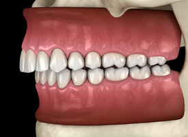 Artistic rendering profile view of an overbite with black background