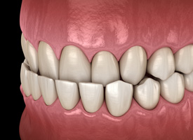 Rendering of an underbite with a black background