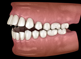 Rendering of a profile view of an open bite with a black background