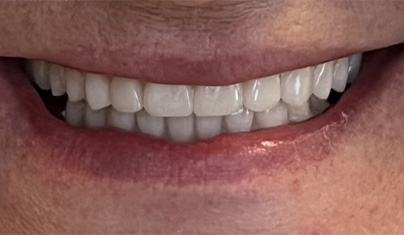 Bright smile after teeth whitening