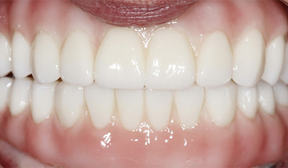 Bright smile after teeth whitening