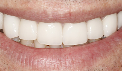 Bright smile after teeth whitening