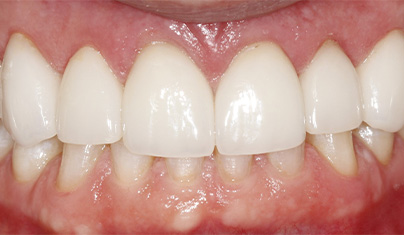 Bright smile after teeth whitening